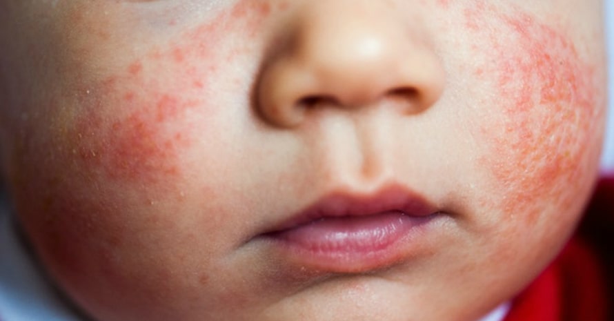 image of early stage of baby eczema